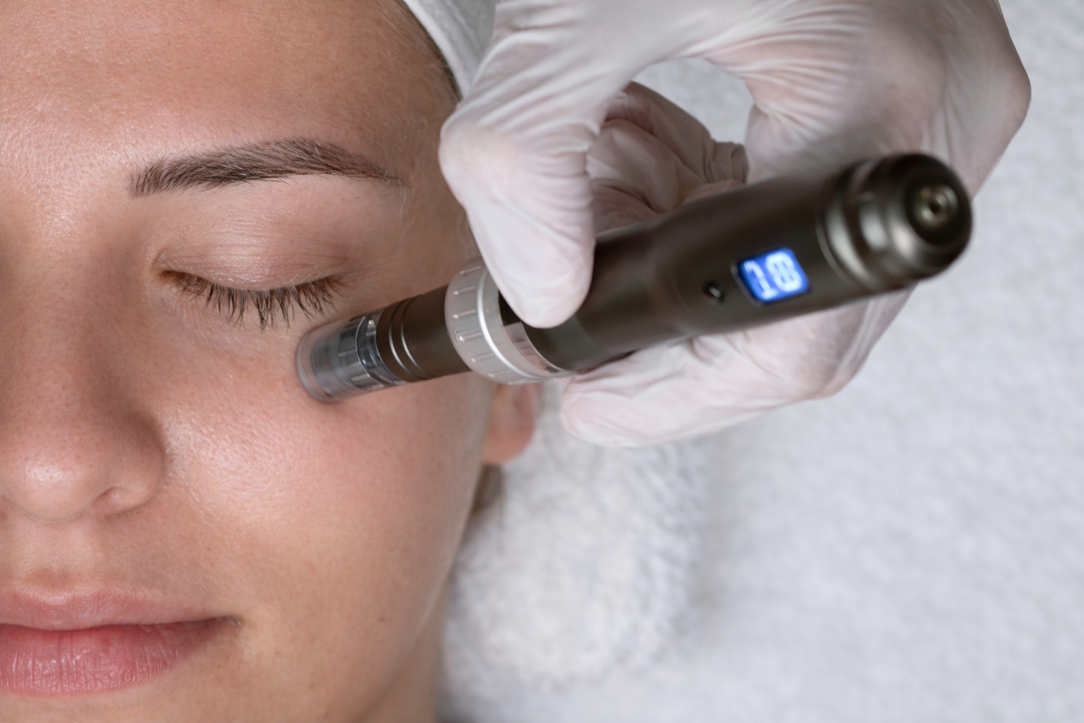 Behandlingsbillede med microneedling i klinikken